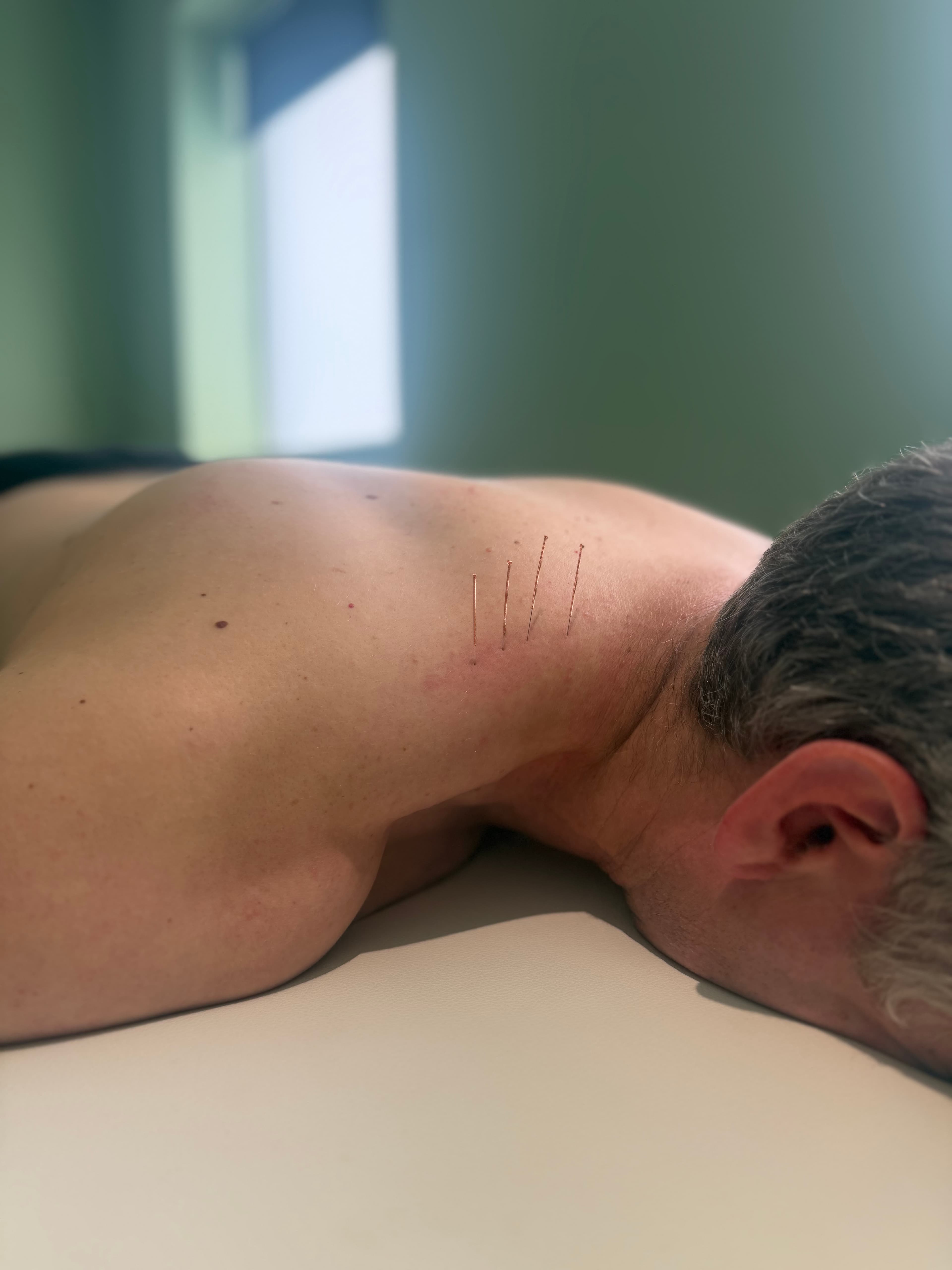 Dry needling treatment provided by Areeb Rashid at Cube Fitness Hornsby